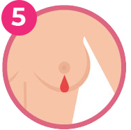 Bleeding or serum from the nipple